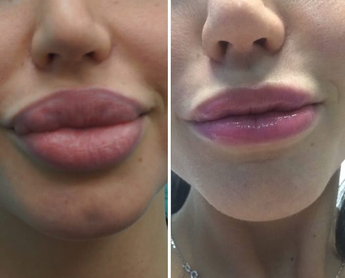 фото до и после уменьшения губ