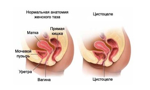 Нормальная анатомия женского таза и цистоцеле