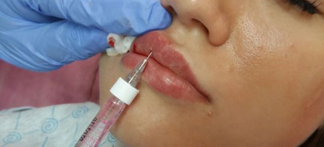 Чем мазать губы после увеличения гиалуроновой кислотой?