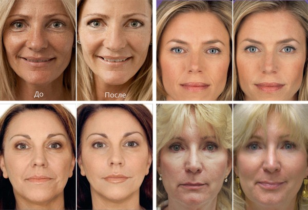 Сферогель в косметологии для лица. Цена, фото до и после, отзывы