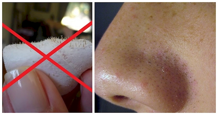 Как очистить кожу лица от забитых пор — 9 советов