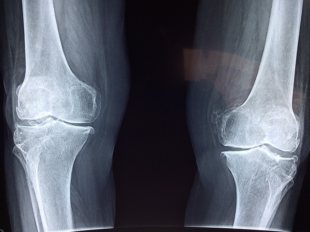 Артрит коленного сустава. Лечение